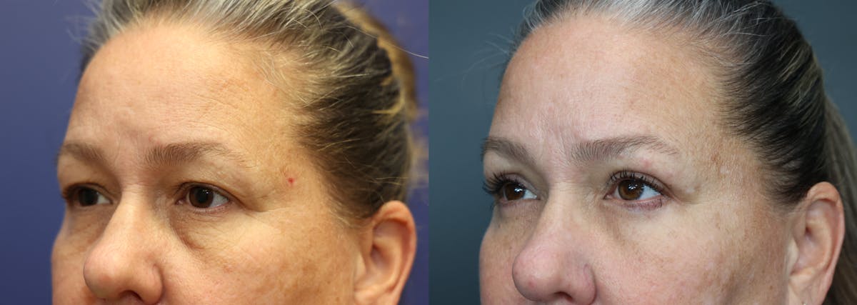 Eyelid Surgery Before & After Gallery - Patient 161319 - Image 2