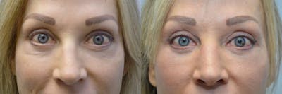 Facial Revolumizing (Fat Transfer) Before & After Gallery - Patient 241321 - Image 1