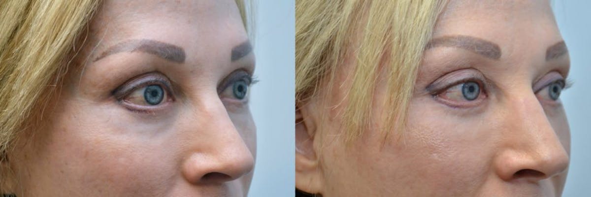 Facial Revolumizing (Fat Grafting) Before & After Gallery - Patient 256316 - Image 2