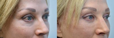 Facial Revolumizing (Fat Transfer) Before & After Gallery - Patient 241321 - Image 2