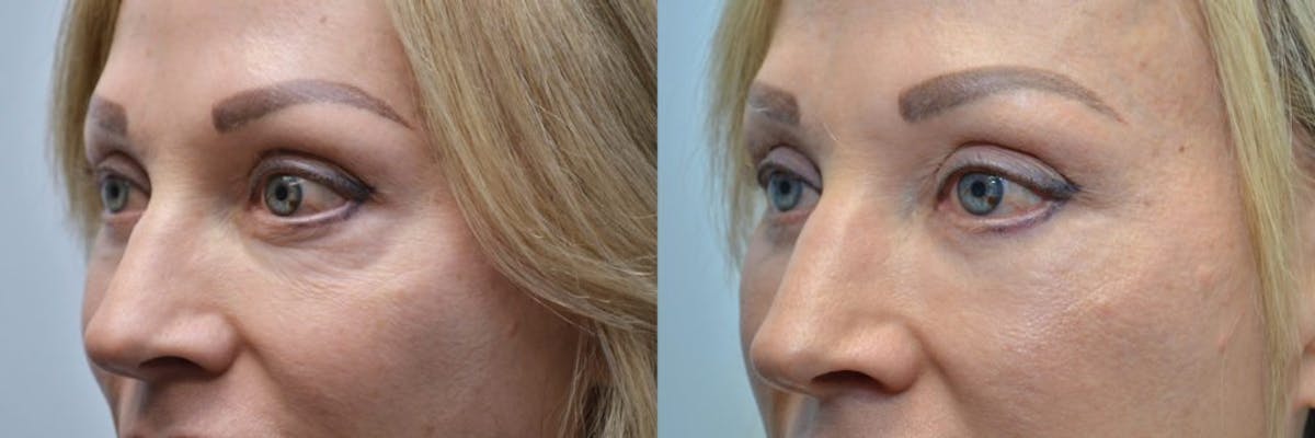Facial Revolumizing (Fat Grafting) Before & After Gallery - Patient 256316 - Image 3