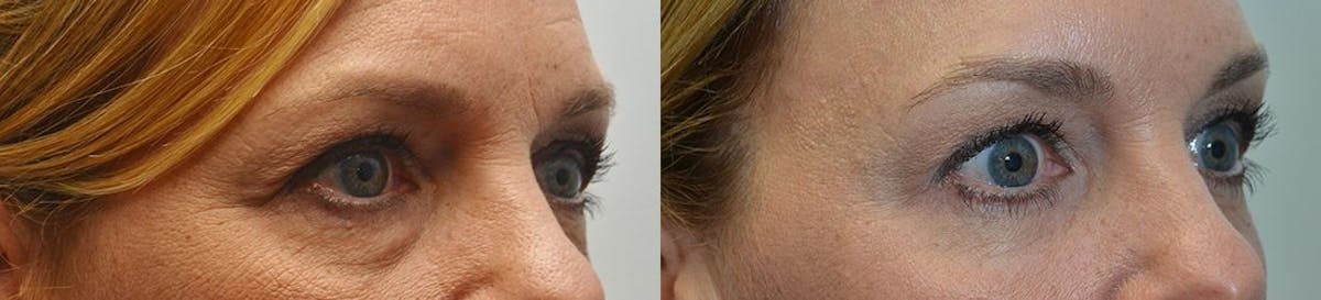 Facial Revolumizing (Fat Grafting) Before & After Gallery - Patient 673897 - Image 1