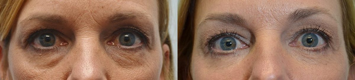 Eyelid Surgery Before & After Gallery - Patient 349784 - Image 1