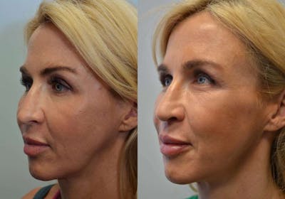 Facial Revolumizing (Fat Transfer) Before & After Gallery - Patient 116562 - Image 1