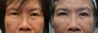 Facial Revolumizing (Fat Transfer) Before & After Gallery - Patient 723205 - Image 1