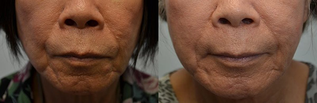 Facial Revolumizing (Fat Grafting) Before & After Gallery - Patient 601222 - Image 2