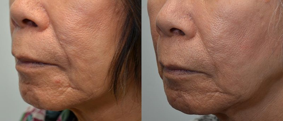 Facial Revolumizing (Fat Grafting) Before & After Gallery - Patient 601222 - Image 3