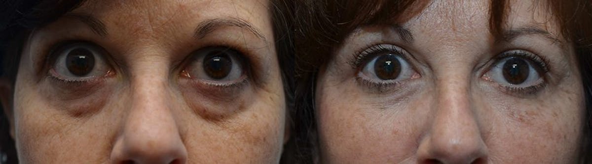 Facial Revolumizing (Fat Transfer) Before & After Gallery - Patient 120254 - Image 1