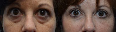 Facial Revolumizing (Fat Transfer) Before & After Gallery - Patient 120254 - Image 1