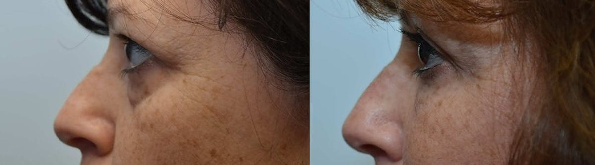 Facial Revolumizing (Fat Transfer) Before & After Gallery - Patient 120254 - Image 2
