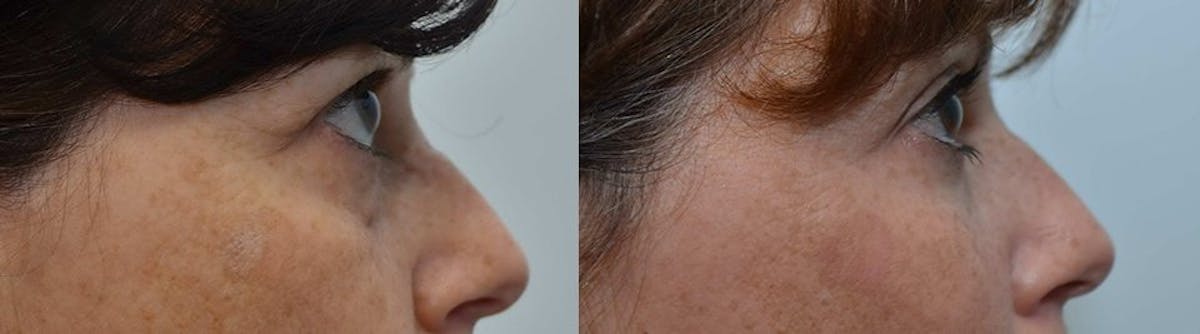 Facial Revolumizing (Fat Transfer) Before & After Gallery - Patient 120254 - Image 3