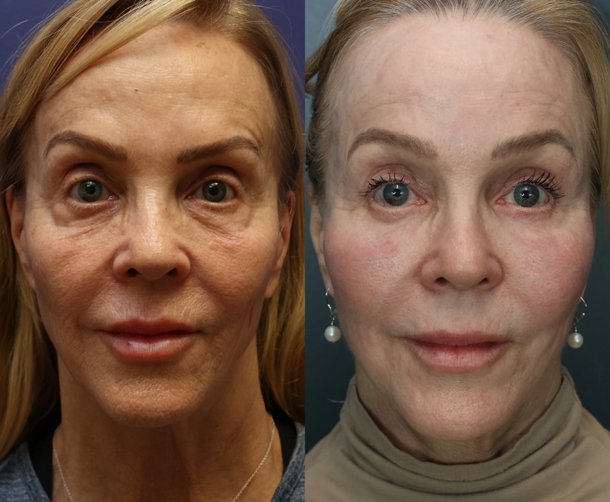 Eyelid Surgery Before & After Gallery - Patient 315820 - Image 1
