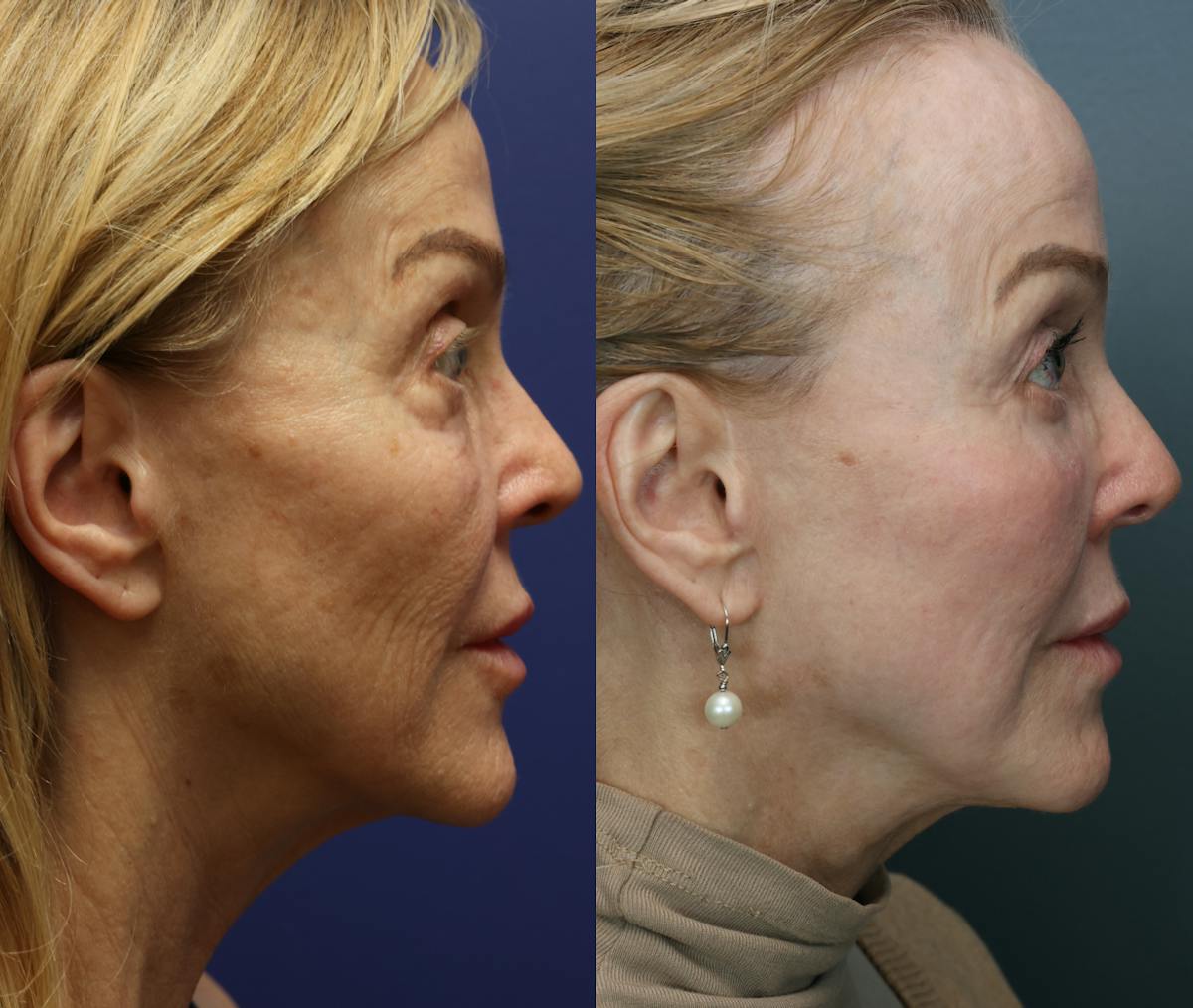 Eyelid Surgery Before & After Gallery - Patient 315820 - Image 3