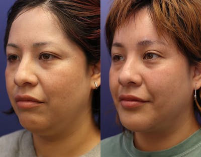 Brow Lift (Forehead Lift) Before & After Gallery - Patient 103343 - Image 1