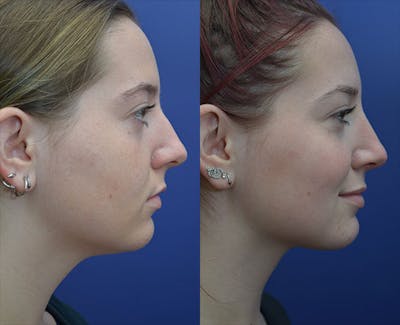Liposuction Before & After Gallery - Patient 219402 - Image 1