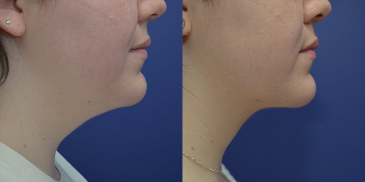 Liposuction Before & After Gallery - Patient 239680 - Image 1