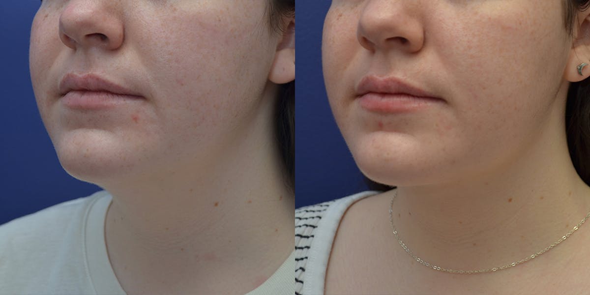 Liposuction Before & After Gallery - Patient 239680 - Image 3