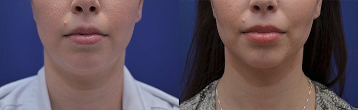 Liposuction Before & After Gallery - Patient 233120 - Image 2