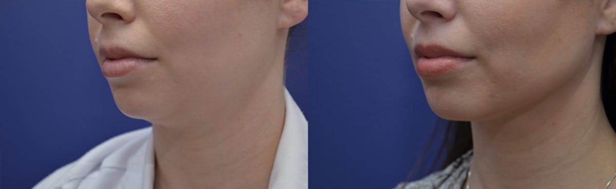 Liposuction Before & After Gallery - Patient 233120 - Image 3