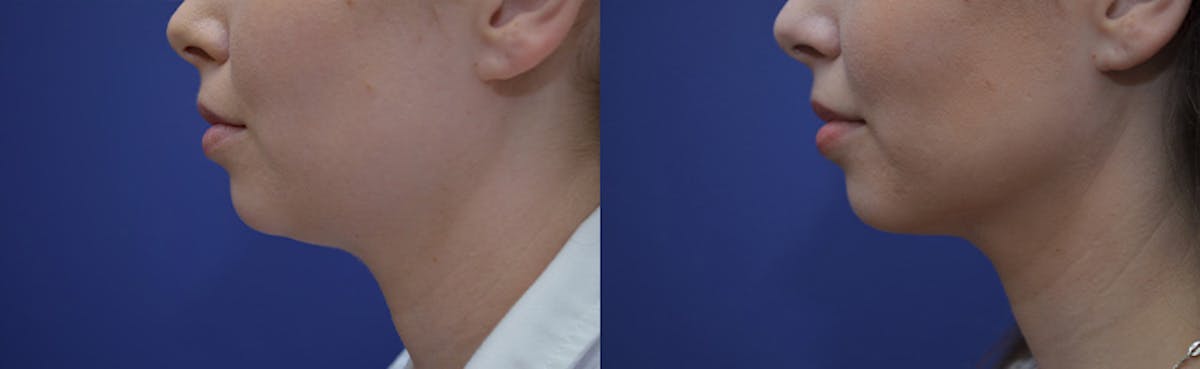 Liposuction Before & After Gallery - Patient 233120 - Image 4