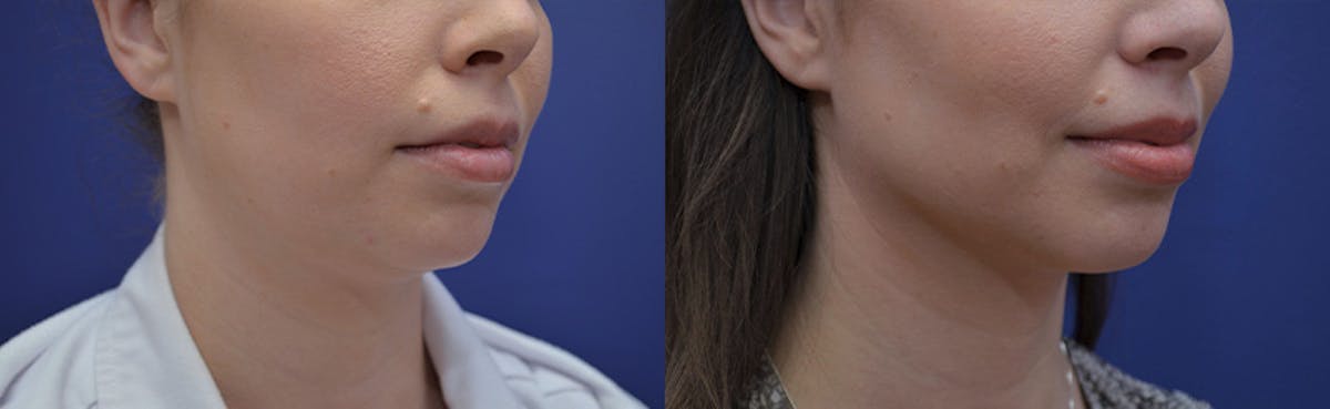 Liposuction Before & After Gallery - Patient 233120 - Image 5