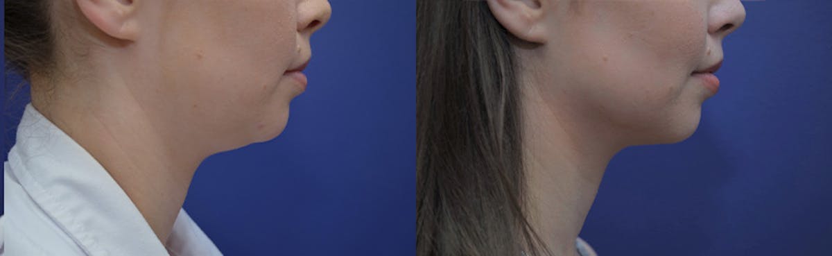 Liposuction Before & After Gallery - Patient 233120 - Image 1