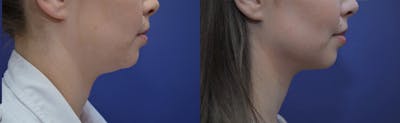 Liposuction Before & After Gallery - Patient 233120 - Image 1