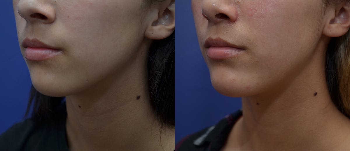 Chin Augmentation Before & After Gallery - Patient 371313 - Image 1
