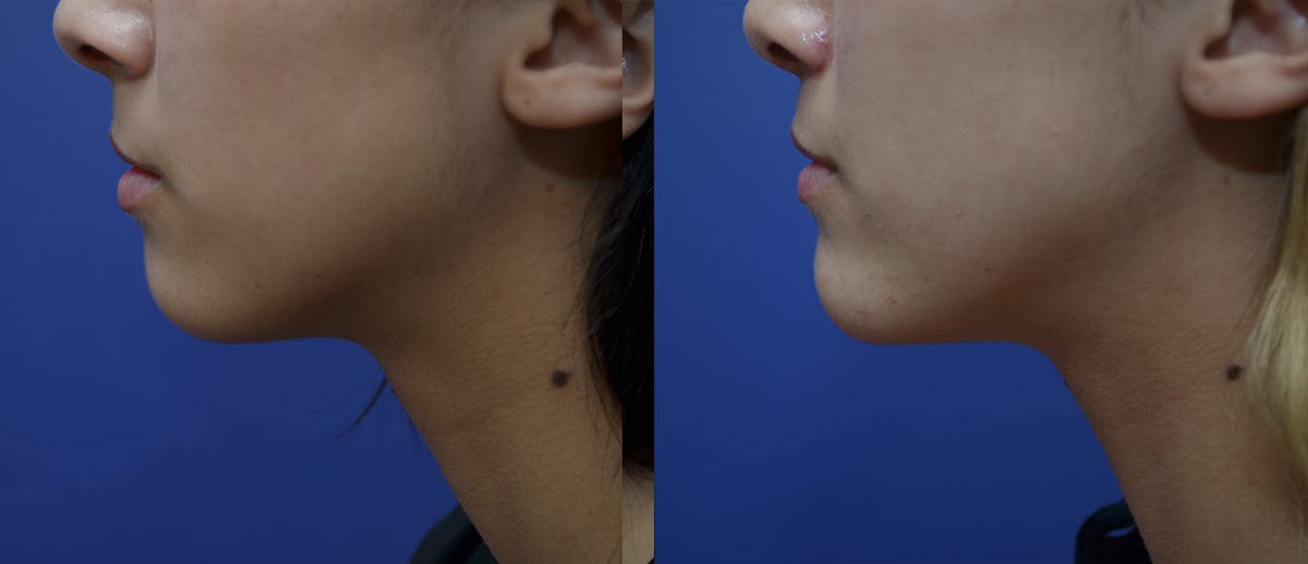 Chin Augmentation Before & After Gallery - Patient 371313 - Image 2