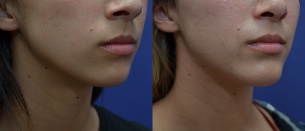 Chin Augmentation Before & After Gallery - Patient 371313 - Image 3