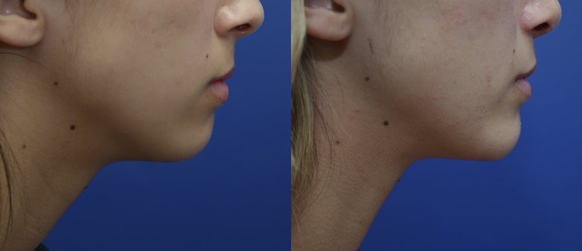 Chin Augmentation Before & After Gallery - Patient 371313 - Image 4