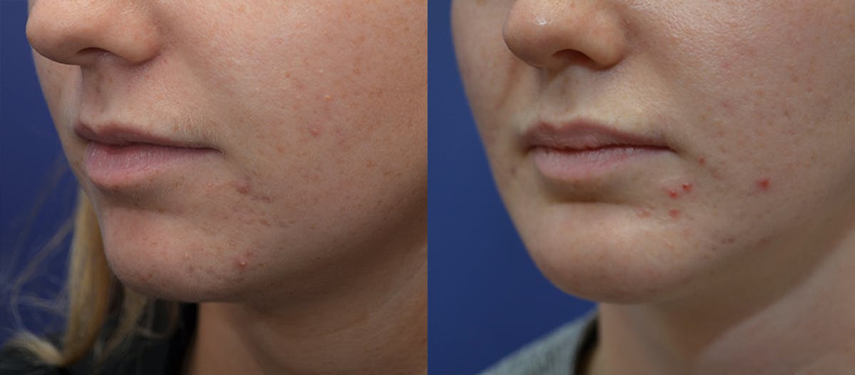 Lip Augmentation Before & After Gallery - Patient 401638 - Image 2
