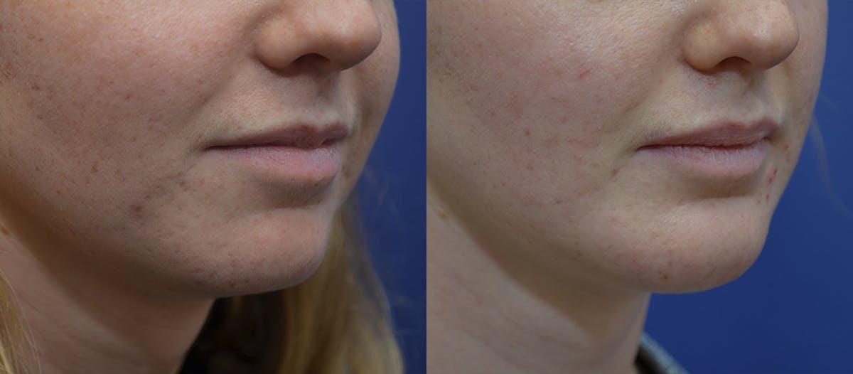 Lip Augmentation Before & After Gallery - Patient 401638 - Image 4
