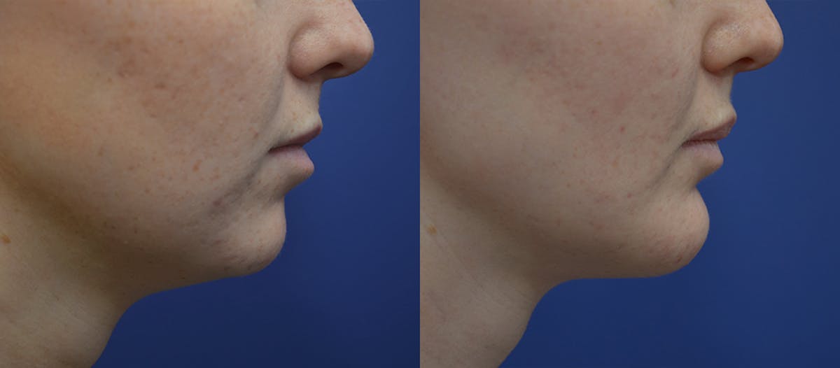 Lip Augmentation Before & After Gallery - Patient 401638 - Image 5