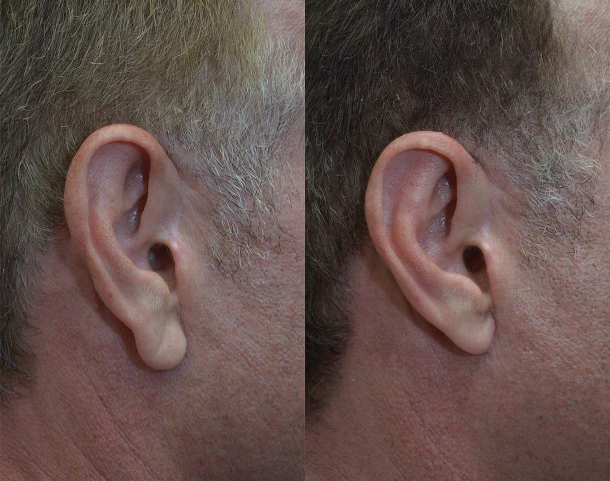 Ear Reshaping (Otoplasty) Before & After Gallery - Patient 125000 - Image 1