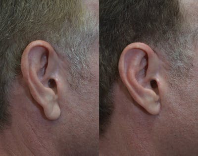 Ear Reshaping (Otoplasty) Before & After Gallery - Patient 125000 - Image 1