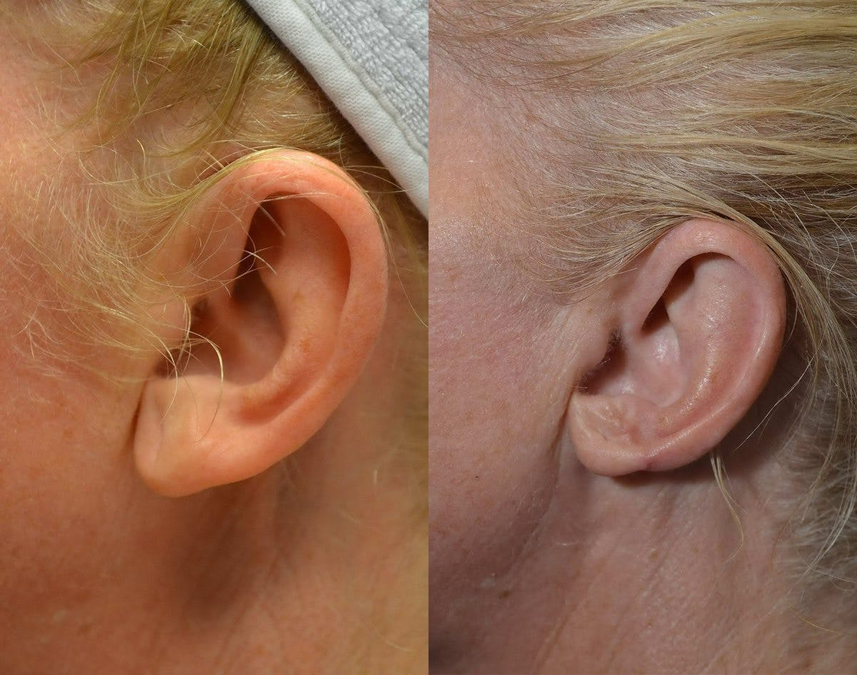 Ear Reshaping (Otoplasty) Before & After Gallery - Patient 296160 - Image 1