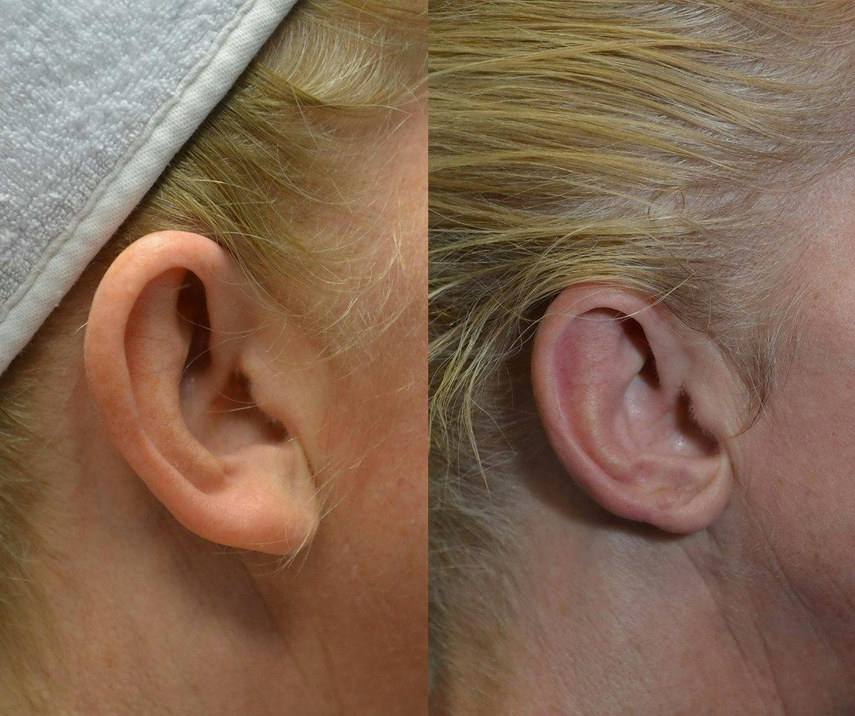 Ear Reshaping (Otoplasty) Before & After Gallery - Patient 296160 - Image 2