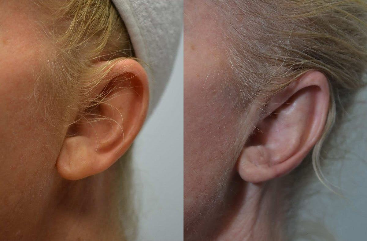 Ear Reshaping (Otoplasty) Before & After Gallery - Patient 296160 - Image 3