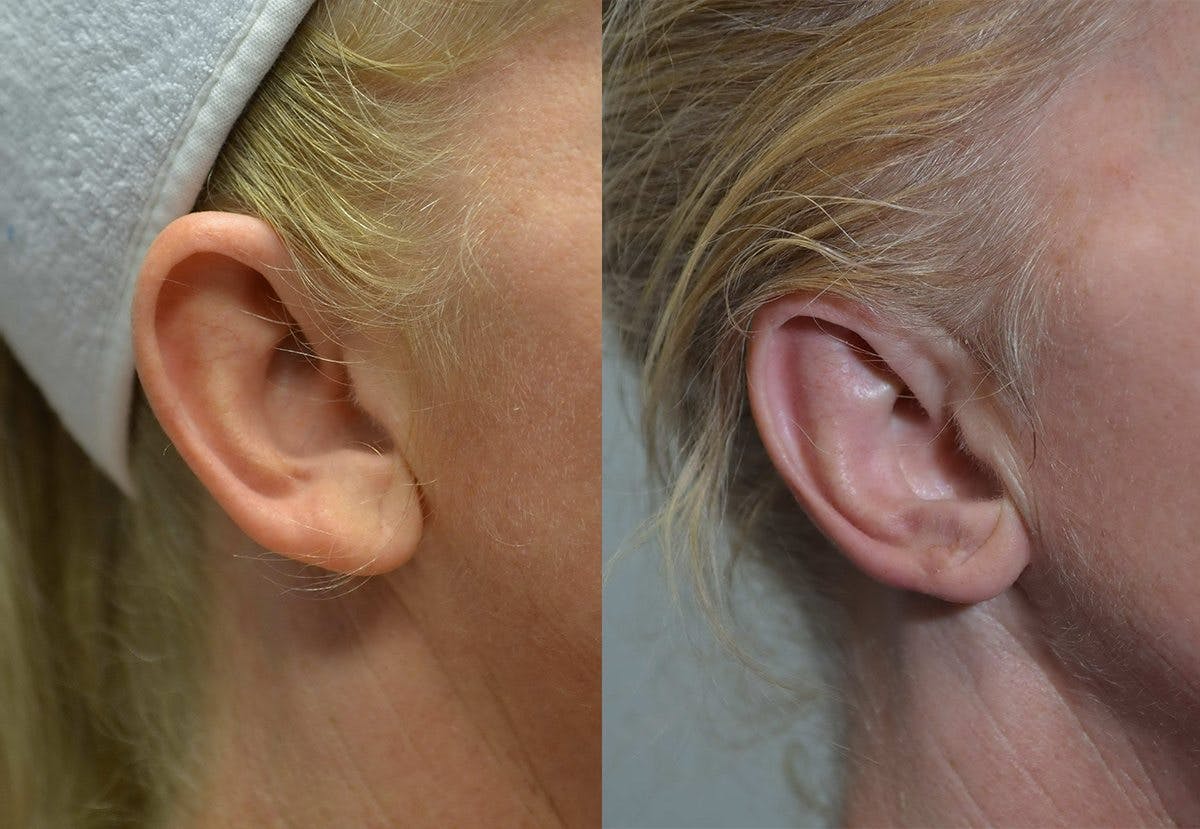 Ear Reshaping (Otoplasty) Before & After Gallery - Patient 296160 - Image 4