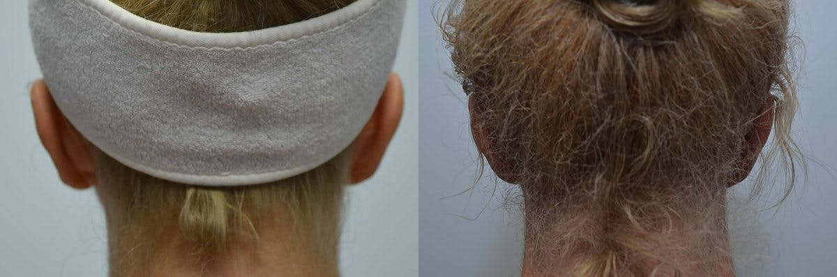 Ear Reshaping (Otoplasty) Before & After Gallery - Patient 296160 - Image 5