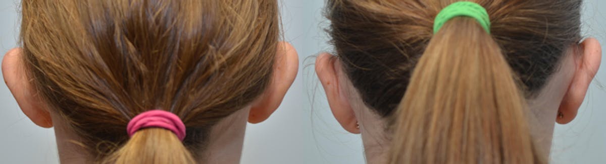 Ear Reshaping (Otoplasty) Before & After Gallery - Patient 155435 - Image 1