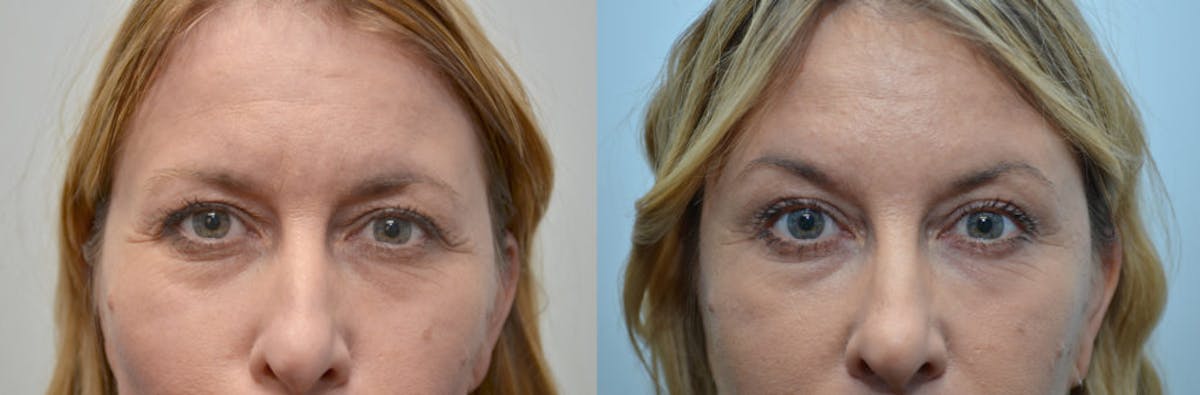 Botox, Xeomin, & Dysport Before & After Gallery - Patient 296601 - Image 1