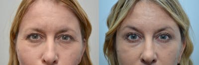 Botox / Xeomin / Dysport Before & After Gallery - Patient 204885 - Image 1