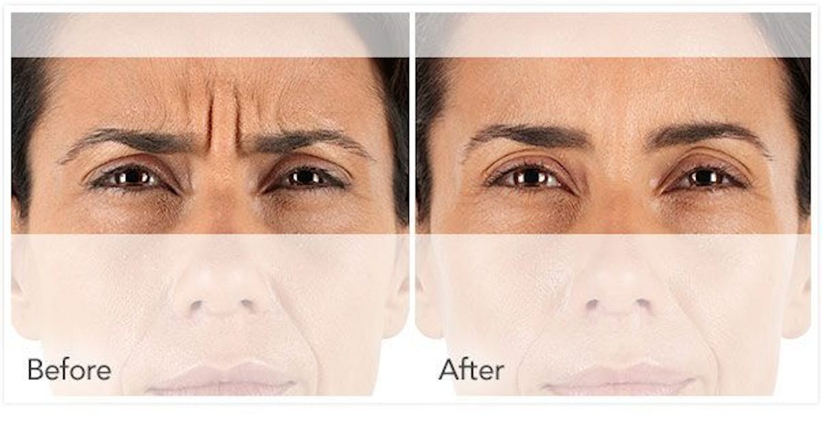 Botox, Xeomin, & Dysport Before & After Gallery - Patient 690706 - Image 1