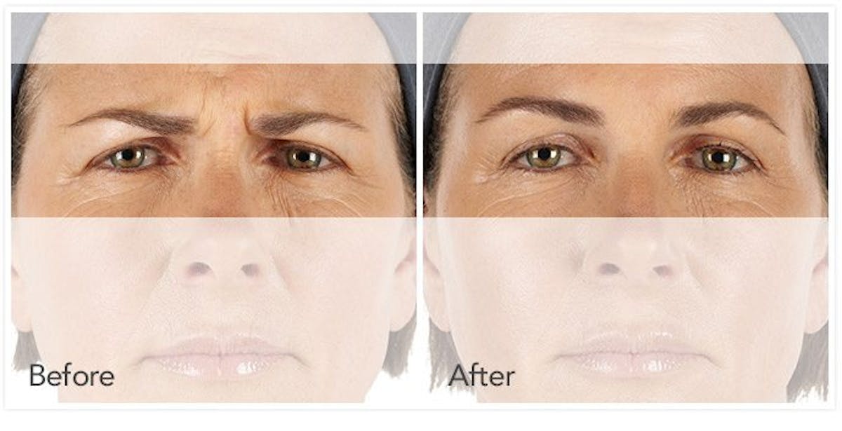 Botox, Xeomin, & Dysport Before & After Gallery - Patient 369542 - Image 1