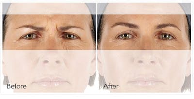 Botox / Xeomin / Dysport Before & After Gallery - Patient 262509 - Image 1