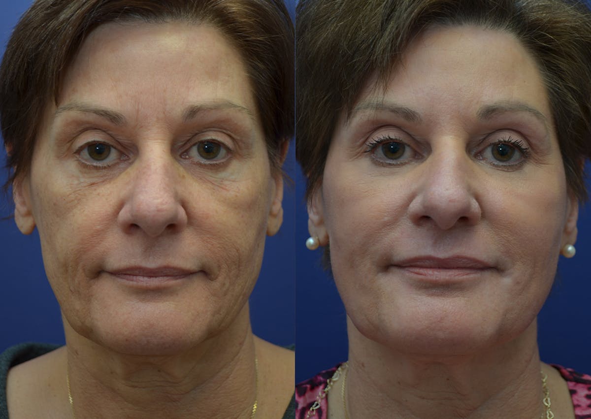 Non-Surgical Soft Tissue Fillers Before & After Gallery - Patient 340218 - Image 1