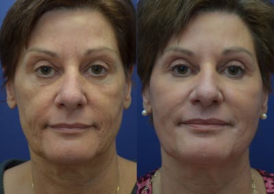 Non-Surgical Soft Tissue Fillers Before & After Gallery - Patient 340218 - Image 1