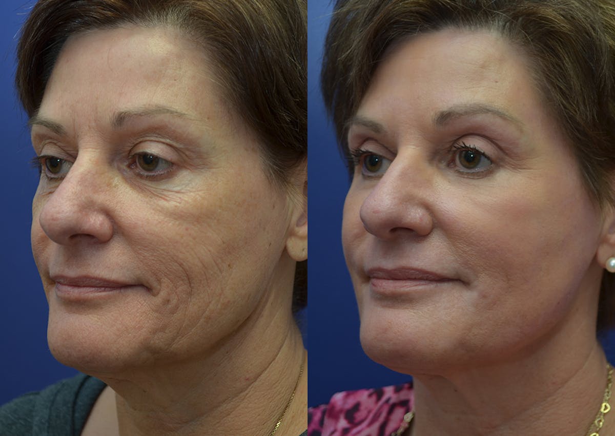 Non-Surgical Soft Tissue Fillers Before & After Gallery - Patient 340218 - Image 2